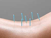 Akupunktur am R&uuml;cken