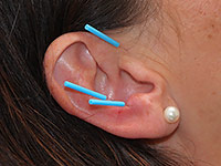 Akupunktur in der Ohrmuschel